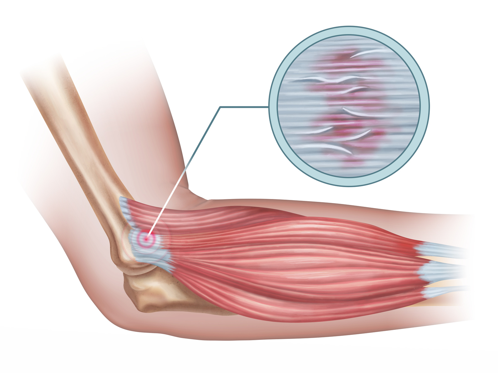 尺側手根伸筋（extensor carpi ulnaris muscle）の構造図